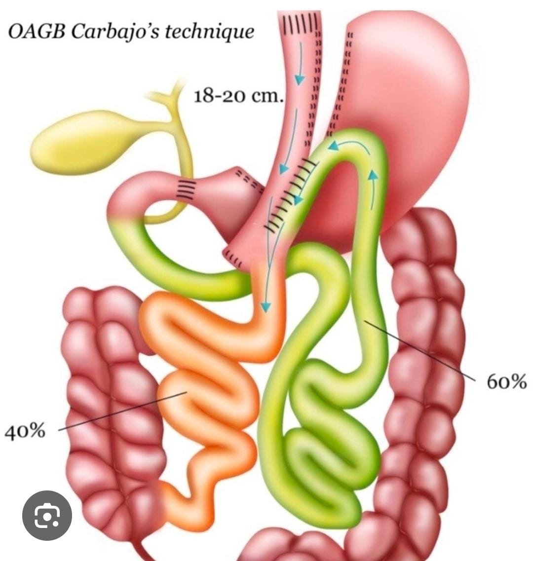 Bypass Gástrico OAGB